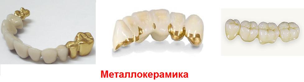 Metallokeramika
