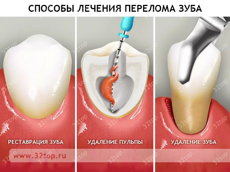 Последствия неудаленных корней зуба Последствия неудаленных корней зуба