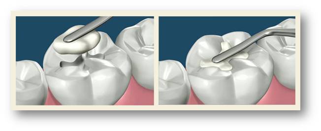 Почему болит зуб после проведенного лечения?