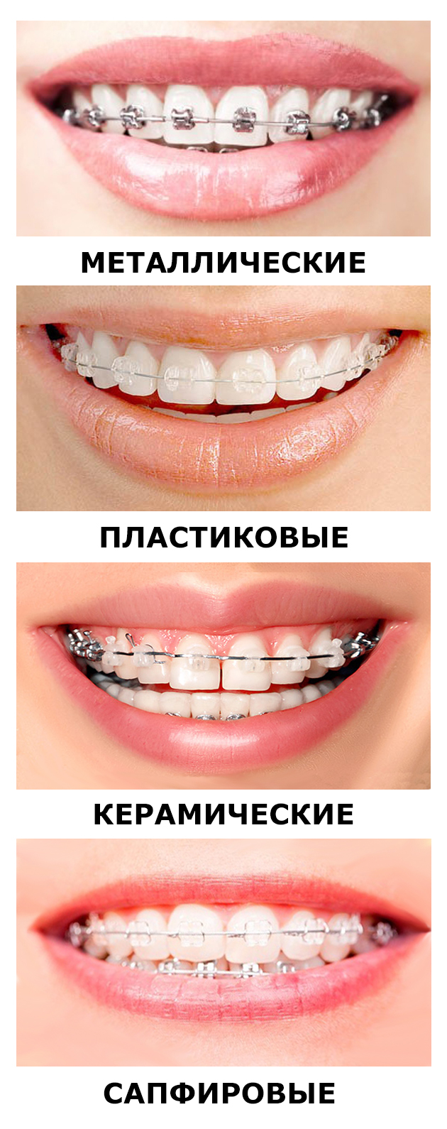 Как выглядят керамические брекеты